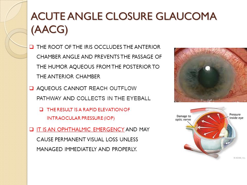 ACUT ANGLE CLOSURE GLAUCOMA ppt video online download